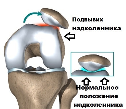 Вывих надколенника
